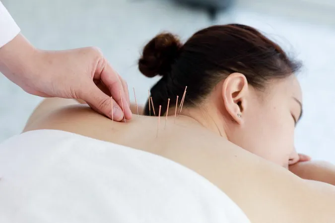 Hand Doctor Performing Acupuncture Therapy Asian Female Undergoing Acupuncture Treatment With Line Fine Needles Inserted Into Her Body Skin Clinic Hospital X - Certified Acupuncturist study guide