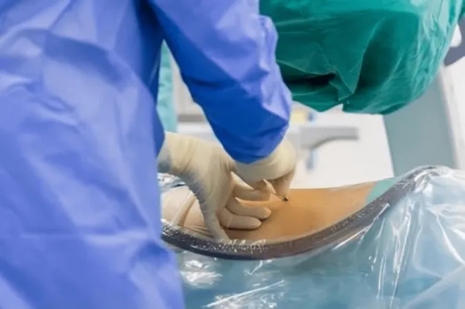 Lumbar Epidural Steroid Injection X - Lumbar Epidural Steroid Injection study guide