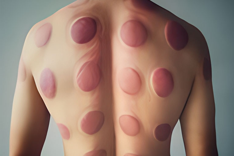 What is Cupping Theraphy